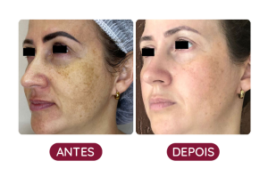 Antes e Depois