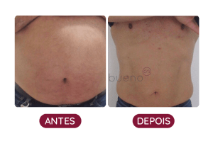 Antes e Depois