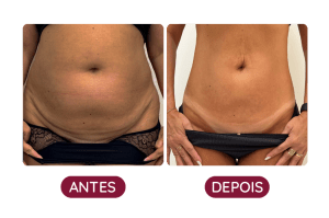 Antes e Depois