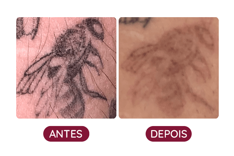 Remoção de Tatuagem em Brasília, tudo que você precisa saber