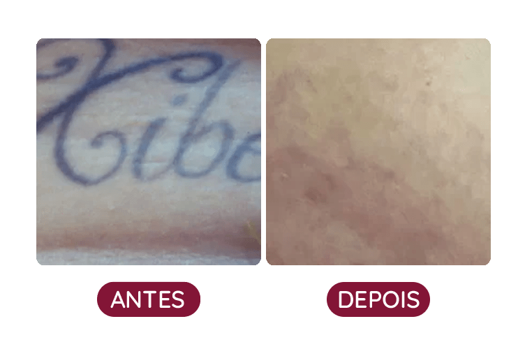 Remoção de Tatuagem na Corpo Bueno de Brasília