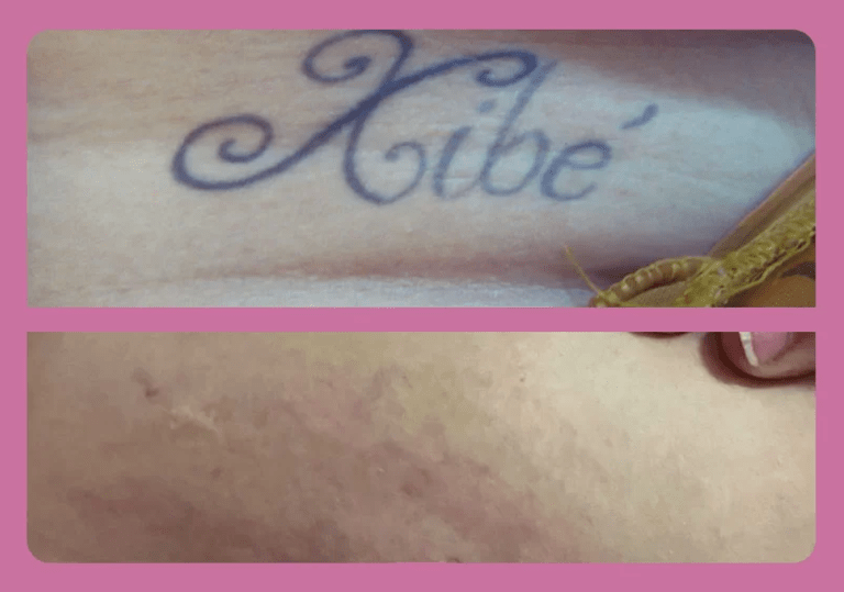 remoçao de tatuagem em brasilia