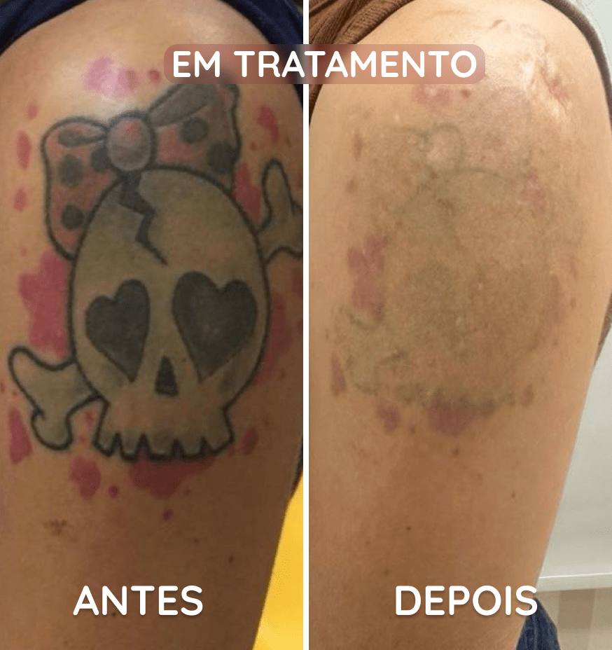 remoção de tatuagem em Brasilia