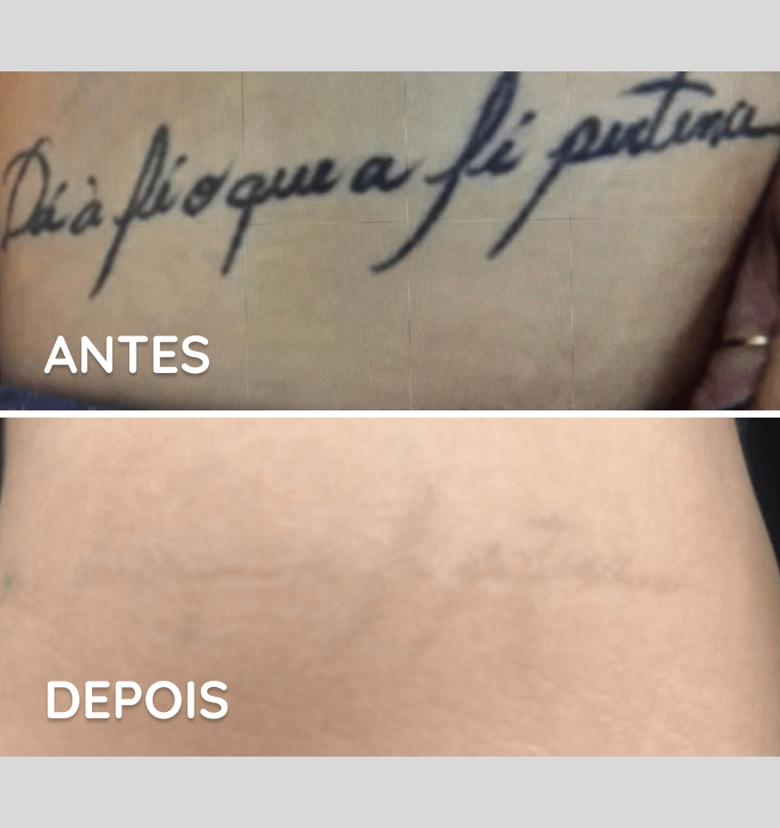 Remoção de tatuagem em Brasília