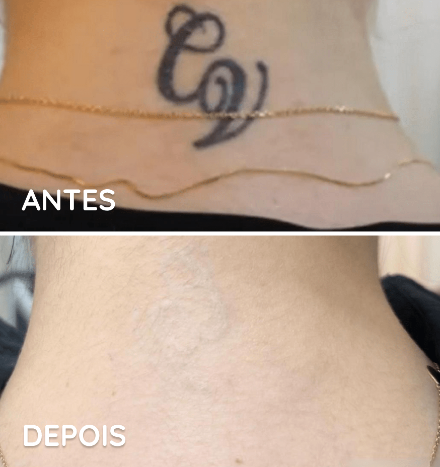 Remoção de Tatuagem Eficaz: Tudo que você precisa saber!